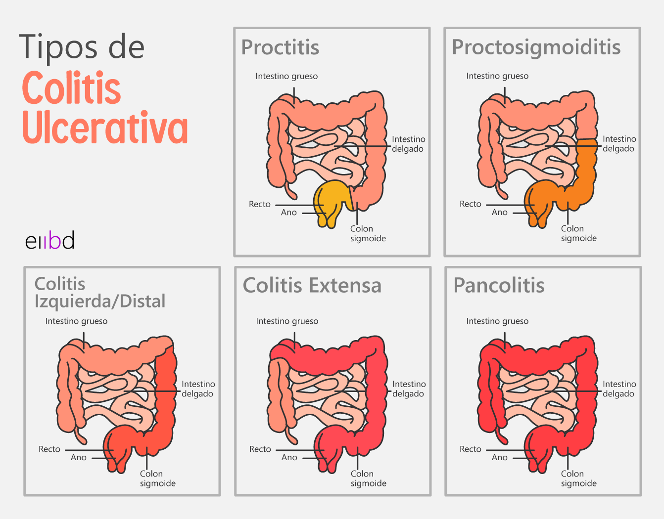 Tipos de CUCI y Síntomas